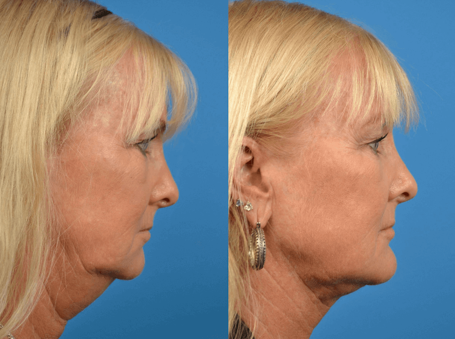 Laser Assisted Weekend Neck Lift In Central Florida